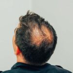 Turkeyana Clinic Hair Transplant